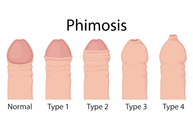 Phimosis